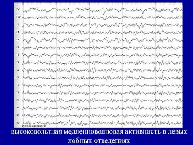 высоковольтная медленноволновая активность в левых лобных отведениях