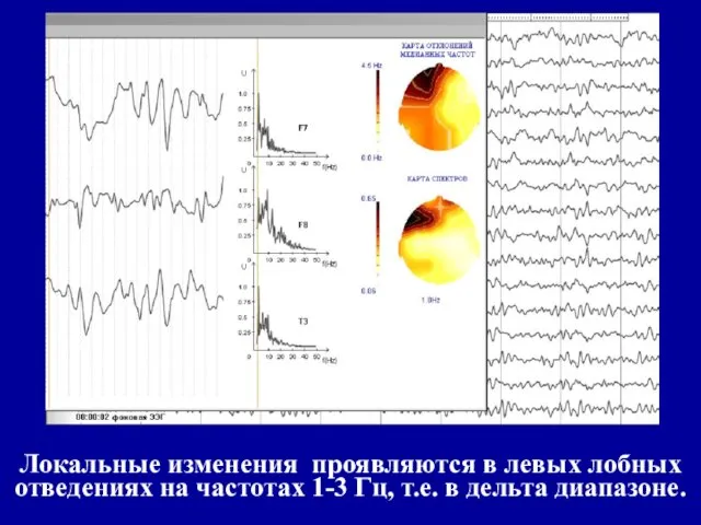 Локальные изменения проявляются в левых лобных отведениях на частотах 1-3 Гц, т.е. в дельта диапазоне.