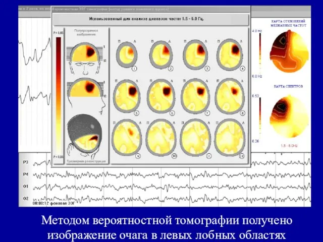 Методом вероятностной томографии получено изображение очага в левых лобных областях