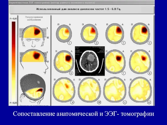 Сопоставление анатомической и ЭЭГ- томографии