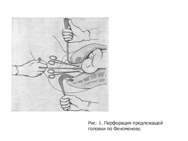 Рис. 1. Перфорация предлежащей головки по Феноменову.