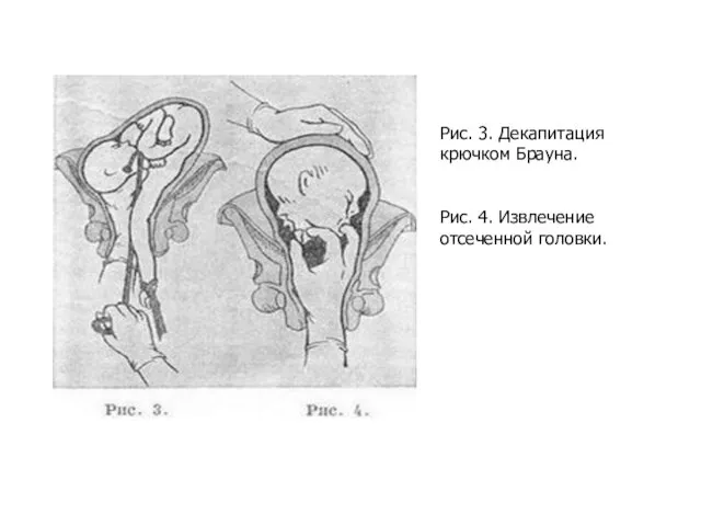 Рис. 3. Декапитация крючком Брауна. Рис. 4. Извлечение отсеченной головки.