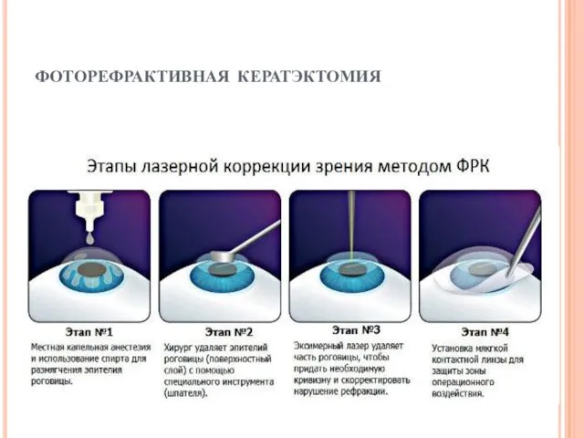 фоторефрактивная кератэктомия