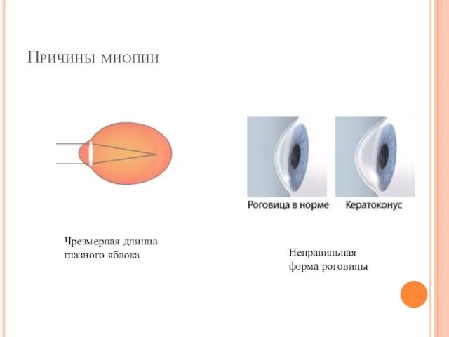 Причины миопии Неправильная форма роговицы Чрезмерная длинна глазного яблока