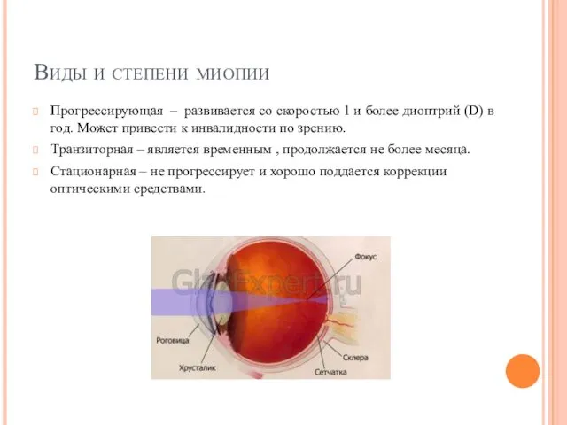 Виды и степени миопии Прогрессирующая – развивается со скоростью 1 и