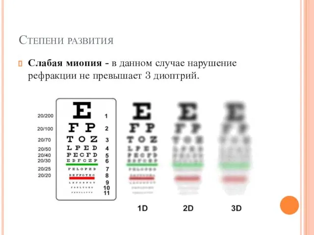 Степени развития Слабая миопия - в данном случае нарушение рефракции не превышает 3 диоптрий.