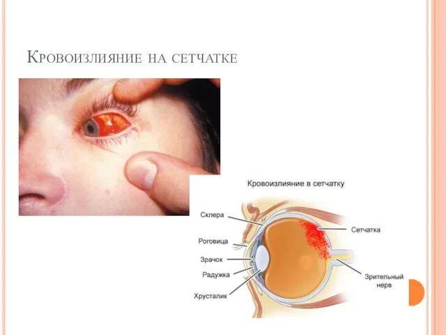 Кровоизлияние на сетчатке