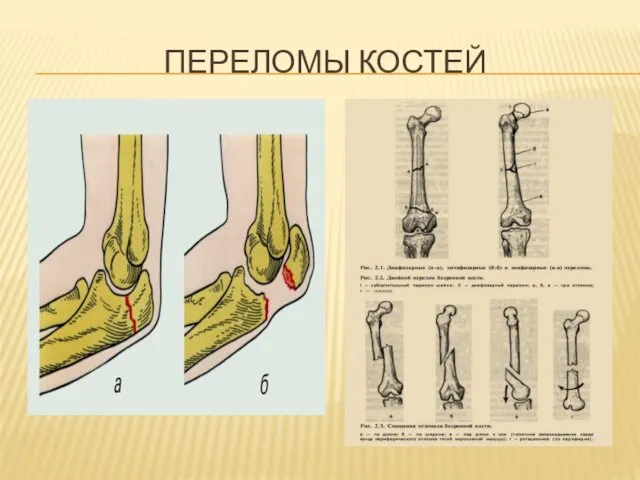 ПЕРЕЛОМЫ КОСТЕЙ