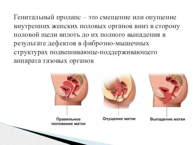 Генитальный пролапс – это смещение или опущение внутренних женских половых органов