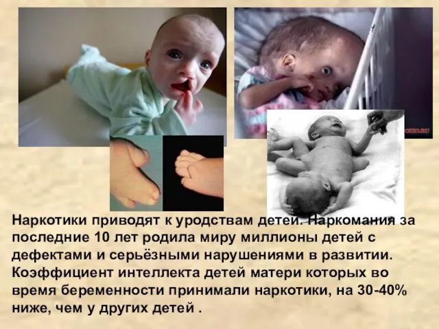 Наркотики приводят к уродствам детей. Наркомания за последние 10 лет родила