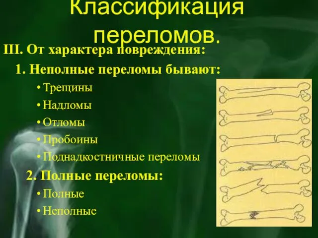 Классификация переломов. III. От характера повреждения: 1. Неполные переломы бывают: Трещины