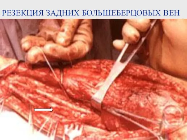 РЕЗЕКЦИЯ ЗАДНИХ БОЛЬШЕБЕРЦОВЫХ ВЕН