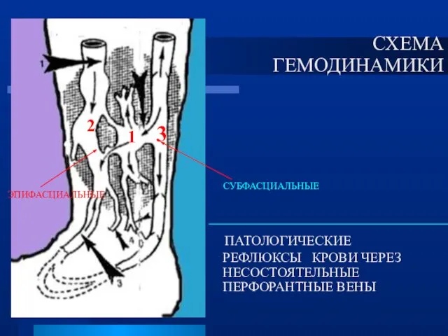 ПАТОЛОГИЧЕСКИЕ РЕФЛЮКСЫ КРОВИ ЧЕРЕЗ НЕСОСТОЯТЕЛЬНЫЕ ПЕРФОРАНТНЫЕ ВЕНЫ СХЕМА ГЕМОДИНАМИКИ 1 2 ЭПИФАСЦИАЛЬНЫЕ СУБФАСЦИАЛЬНЫЕ 3
