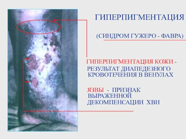 ГИПЕРПИГМЕНТАЦИЯ КОЖИ - РЕЗУЛЬТАТ ДИАПЕДЕЗНОГО КРОВОТЕЧЕНИЯ В ВЕНУЛАХ ЯЗВЫ - ПРИЗНАК