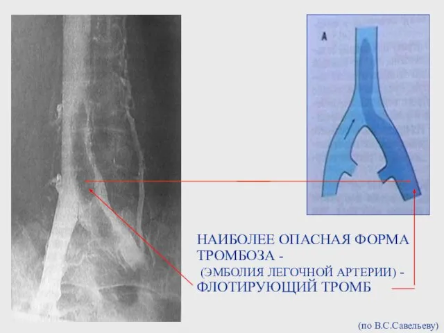 НАИБОЛЕЕ ОПАСНАЯ ФОРМА ТРОМБОЗА - (ЭМБОЛИЯ ЛЕГОЧНОЙ АРТЕРИИ) - ФЛОТИРУЮЩИЙ ТРОМБ (по В.С.Савельеву)