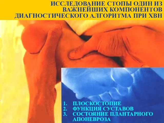 ИССЛЕДОВАНИЕ СТОПЫ ОДИН ИЗ ВАЖНЕЙШИХ КОМПОНЕНТОВ ДИАГНОСТИЧЕСКОГО АЛГОРИТМА ПРИ ХВН ПЛОСКОСТОПИЕ ФУНКЦИЯ СУСТАВОВ СОСТОЯНИЕ ПЛАНТАРНОГО АПОНЕВРОЗА