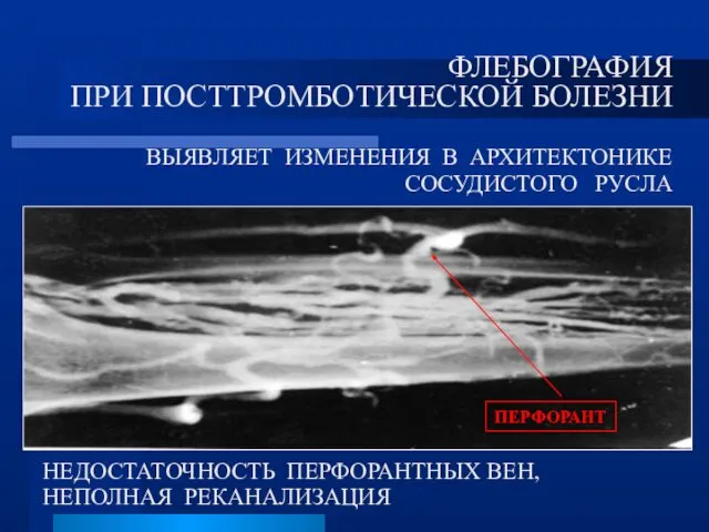 ФЛЕБОГРАФИЯ ПРИ ПОСТТРОМБОТИЧЕСКОЙ БОЛЕЗНИ ВЫЯВЛЯЕТ ИЗМЕНЕНИЯ В АРХИТЕКТОНИКЕ СОСУДИСТОГО РУСЛА НЕДОСТАТОЧНОСТЬ ПЕРФОРАНТНЫХ ВЕН, НЕПОЛНАЯ РЕКАНАЛИЗАЦИЯ ПЕРФОРАНТ