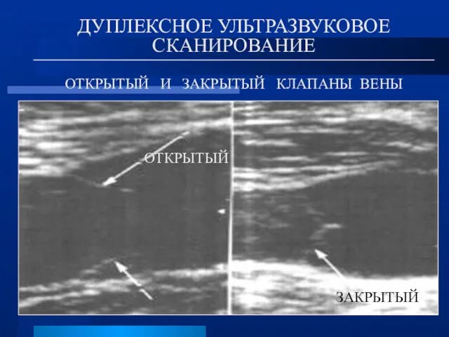 ДУПЛЕКСНОЕ УЛЬТРАЗВУКОВОЕ СКАНИРОВАНИЕ ОТКРЫТЫЙ И ЗАКРЫТЫЙ КЛАПАНЫ ВЕНЫ ОТКРЫТЫЙ ЗАКРЫТЫЙ