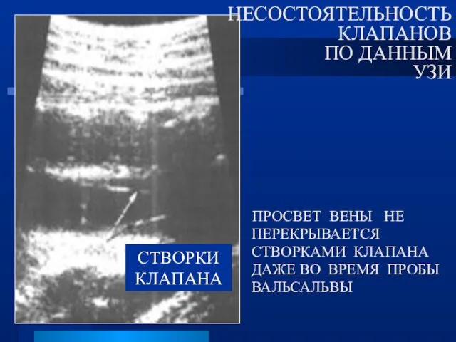 ПРОСВЕТ ВЕНЫ НЕ ПЕРЕКРЫВАЕТСЯ СТВОРКАМИ КЛАПАНА ДАЖЕ ВО ВРЕМЯ ПРОБЫ ВАЛЬСАЛЬВЫ