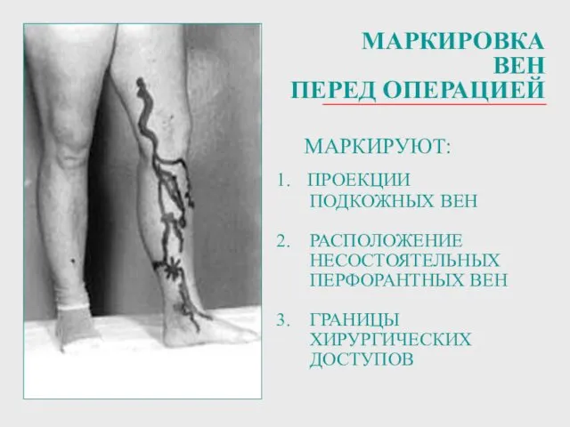 МАРКИРОВКА ВЕН ПЕРЕД ОПЕРАЦИЕЙ МАРКИРУЮТ: 1. ПРОЕКЦИИ ПОДКОЖНЫХ ВЕН 2. РАСПОЛОЖЕНИЕ