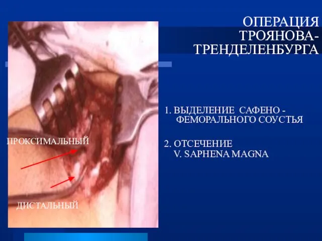 1. ВЫДЕЛЕНИЕ САФЕНО - ФЕМОРАЛЬНОГО СОУСТЬЯ 2. ОТСЕЧЕНИЕ V. SAPHENA MAGNA ОПЕРАЦИЯ ТРОЯНОВА- ТРЕНДЕЛЕНБУРГА ПРОКСИМАЛЬНЫЙ ДИСТАЛЬНЫЙ