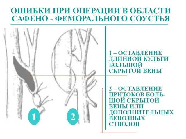 ОШИБКИ ПРИ ОПЕРАЦИИ В ОБЛАСТИ САФЕНО - ФЕМОРАЛЬНОГО СОУСТЬЯ 1 2