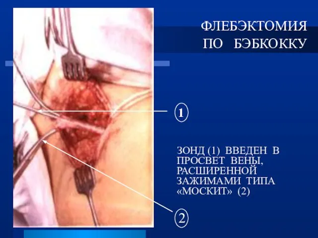 ЗОНД (1) ВВЕДЕН В ПРОСВЕТ ВЕНЫ, РАСШИРЕННОЙ ЗАЖИМАМИ ТИПА «МОСКИТ» (2) ФЛЕБЭКТОМИЯ ПО БЭБКОККУ 1 2