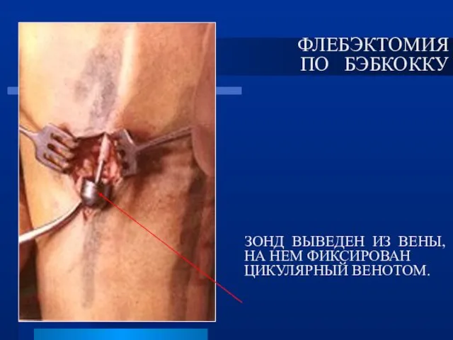 ЗОНД ВЫВЕДЕН ИЗ ВЕНЫ, НА НЕМ ФИКСИРОВАН ЦИКУЛЯРНЫЙ ВЕНОТОМ. ФЛЕБЭКТОМИЯ ПО БЭБКОККУ