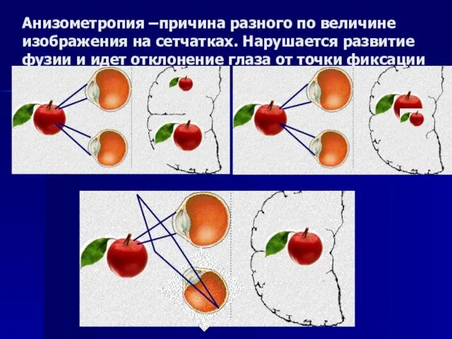 Анизометропия –причина разного по величине изображения на сетчатках. Нарушается развитие фузии