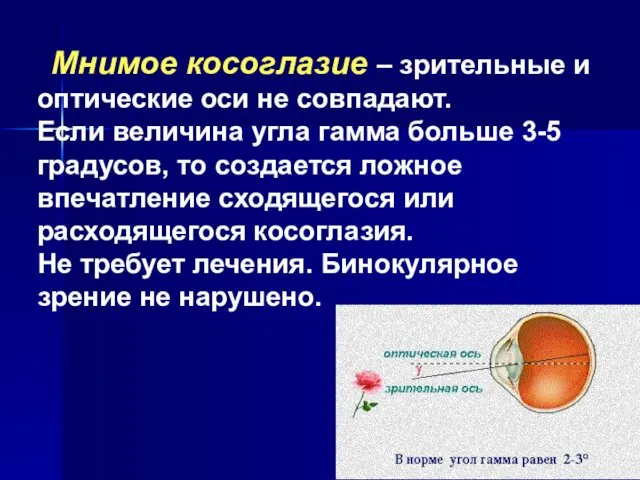 Мнимое косоглазие – зрительные и оптические оси не совпадают. Если величина