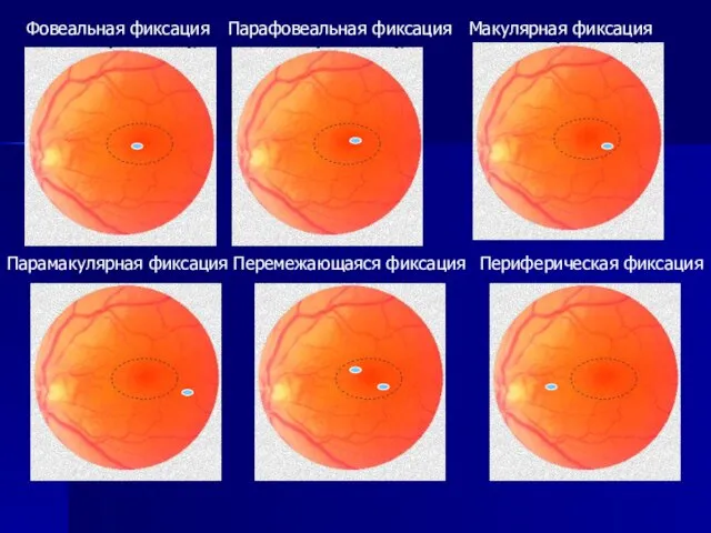 Фовеальная фиксация Периферическая фиксация Перемежающаяся фиксация Парамакулярная фиксация Макулярная фиксация Парафовеальная фиксация