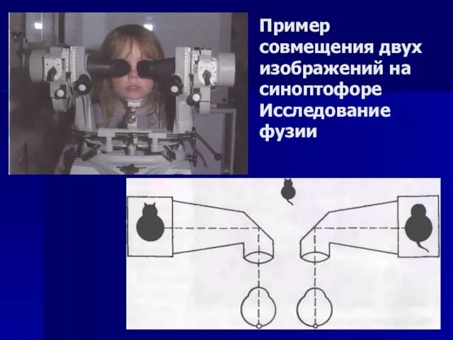 Пример совмещения двух изображений на синоптофоре Исследование фузии