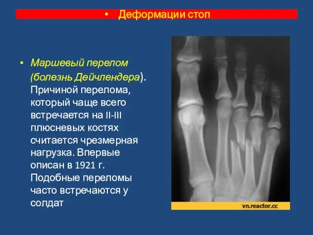 Маршевый перелом (болезнь Дейчлендера). Причиной перелома, который чаще всего встречается на