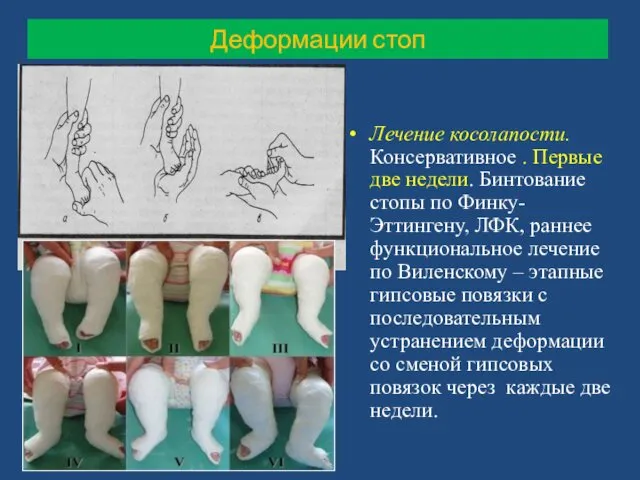 Лечение косолапости. Консервативное . Первые две недели. Бинтование стопы по Финку-