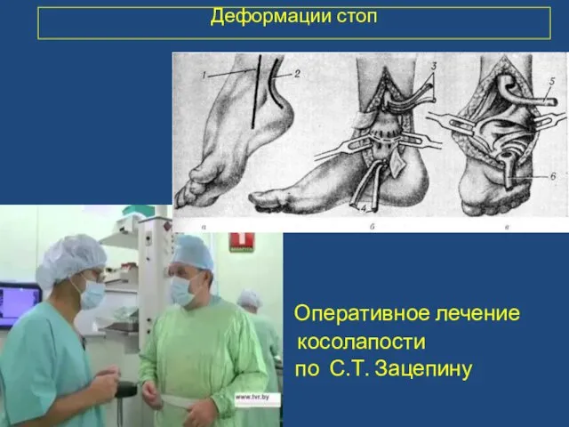 Деформации стоп Оперативное лечение косолапости по С.Т. Зацепину