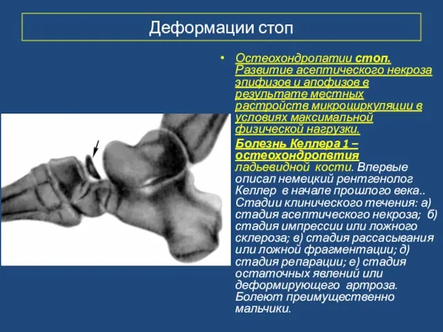 Деформации стоп Остеохондропатии стоп. Развитие асептического некроза эпифизов и апофизов в