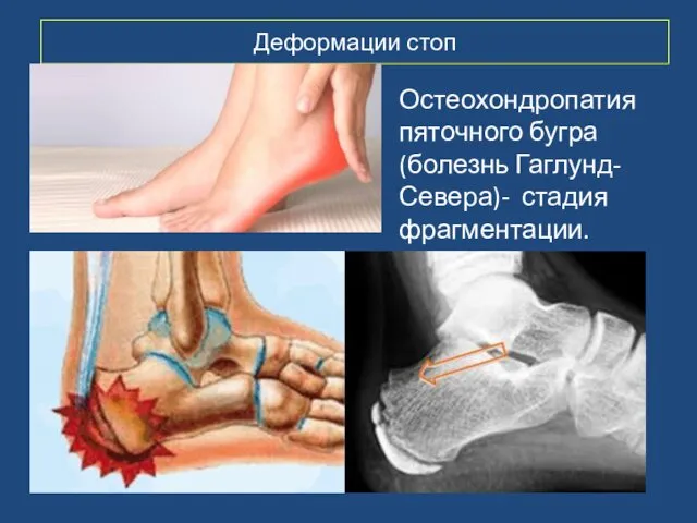 Деформации стоп Остеохондропатия пяточного бугра (болезнь Гаглунд-Севера)- стадия фрагментации.