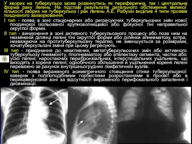 У хворих на туберкульоз може розвинутись як периферична, так і центральна