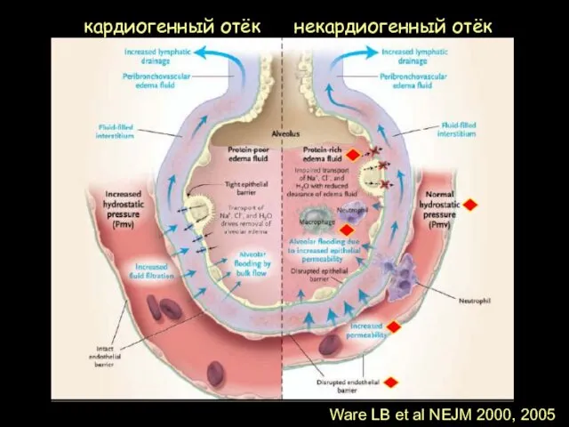 Ware LB et al NEJM 2000, 2005 кардиогенный отёк некардиогенный отёк