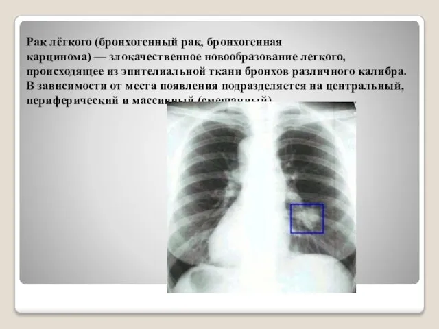 Рак лёгкого (бронхогенный рак, бронхогенная карцинома) — злокачественное новообразование легкого, происходящее