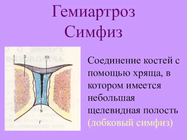 Гемиартроз Симфиз Соединение костей с помощью хряща, в котором имеется небольшая щелевидная полость (лобковый симфиз)