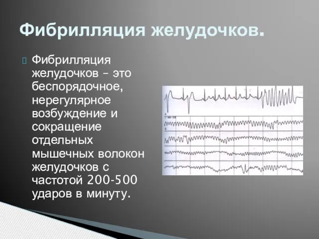 Фибрилляция желудочков – это беспорядочное, нерегулярное возбуждение и сокращение отдельных мышечных