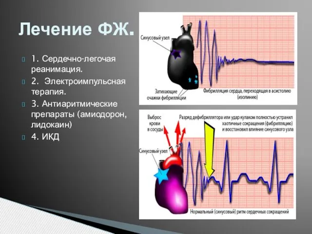 1. Сердечно-легочая реанимация. 2. Электроимпульсная терапия. 3. Антиаритмические препараты (амиодорон, лидокаин) 4. ИКД Лечение ФЖ.