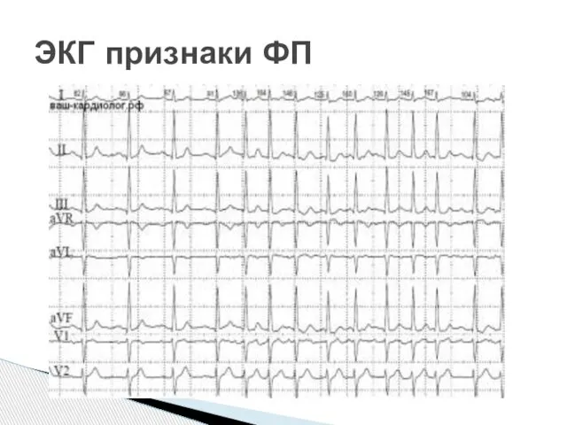 ЭКГ признаки ФП