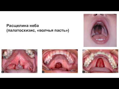 Расщелина неба (палатосхизис, «волчья пасть»)