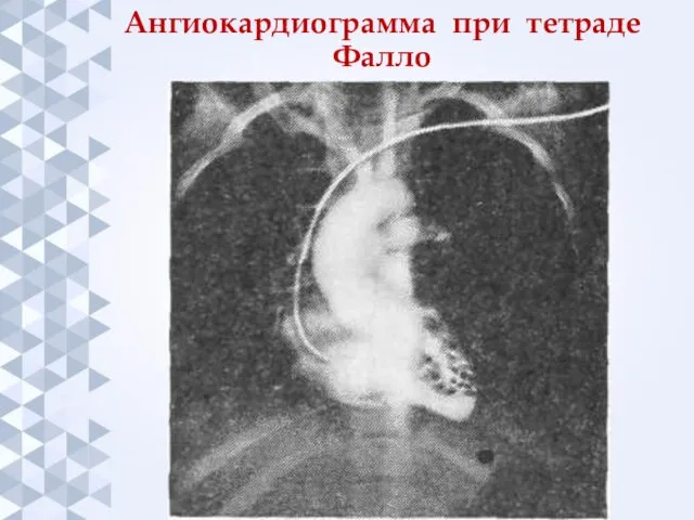 Ангиокардиограмма при тетраде Фалло