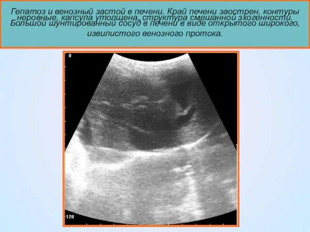 Гепатоз и венозный застой в печени. Край печени заострен, контуры неровные,