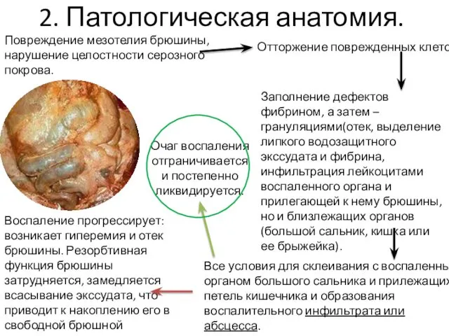 2. Патологическая анатомия. Повреждение мезотелия брюшины, нарушение целостности серозного покрова. Отторжение