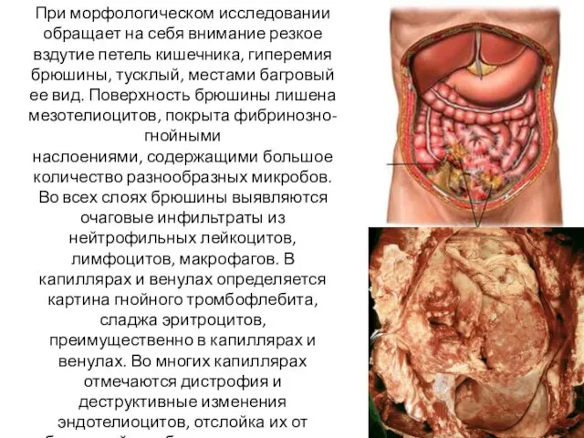 При морфологическом исследовании обращает на себя внимание резкое вздутие петель кишечника,