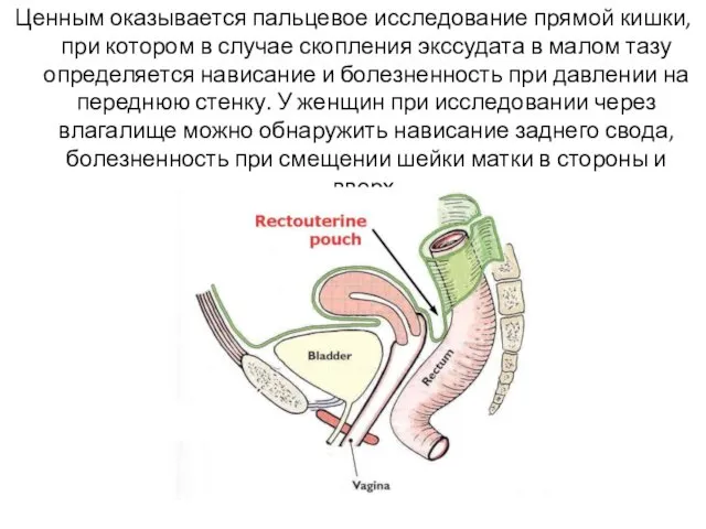 Ценным оказывается пальцевое исследование прямой кишки, при котором в случае скопления